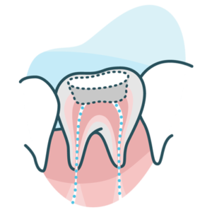 sm-il-dental_root-canal-03-400