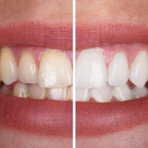 Teeth whitening