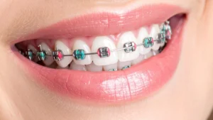 6 Things to Do Before Getting Braces