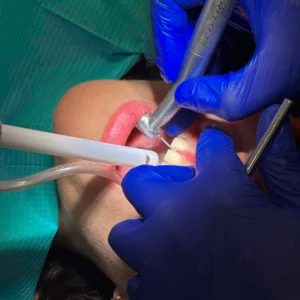 Signs You Might Need a Dental Crown