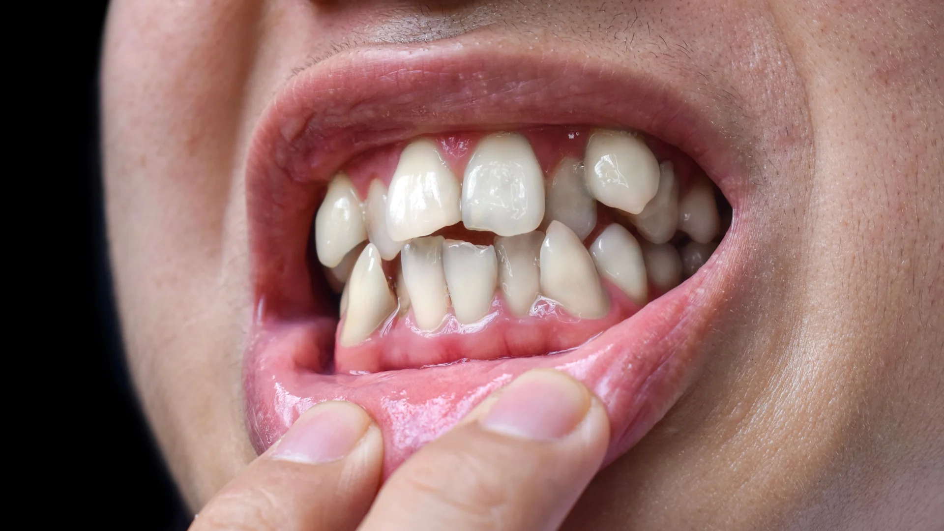 Wisdom Teeth Extractions