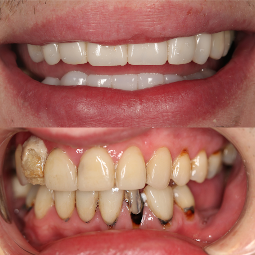 What Is a Dental Crown?