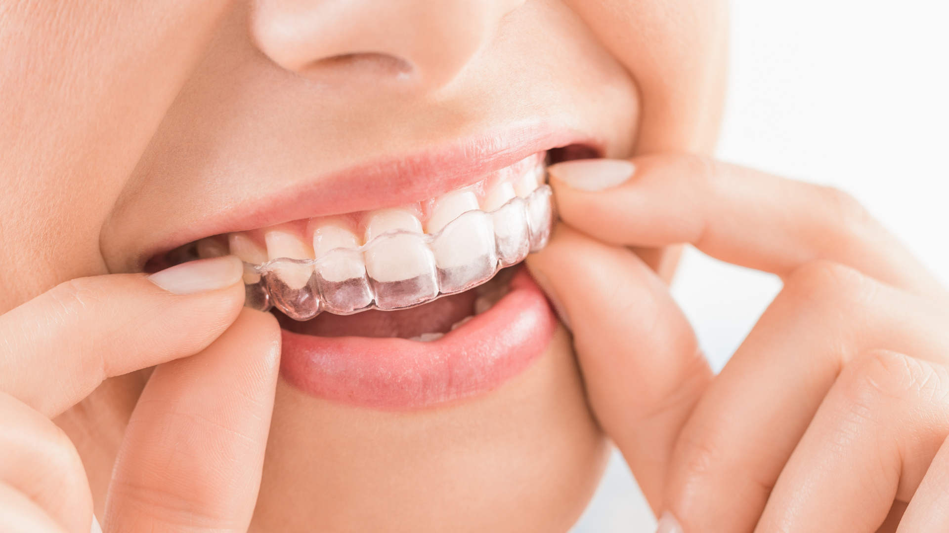 What Is Invisalign®