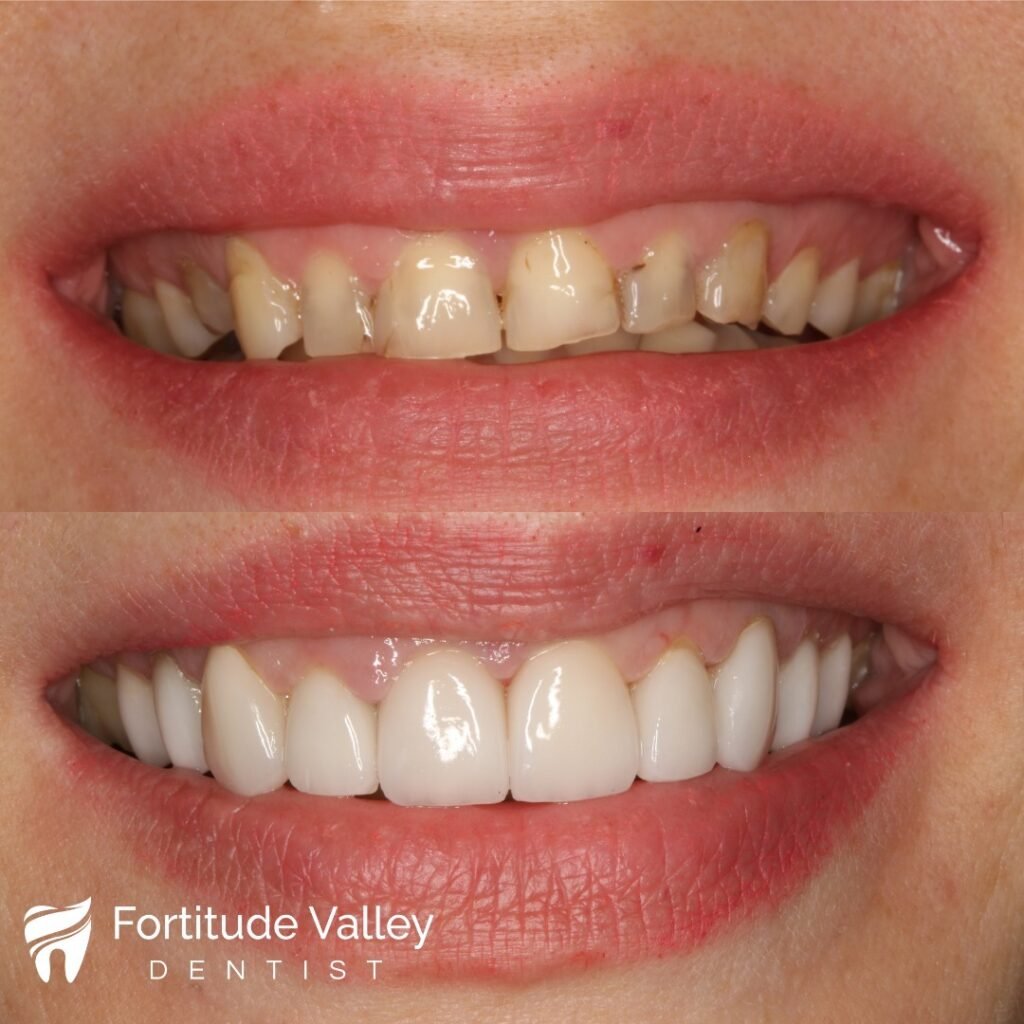 What Is a Dental Crown and Why Choose It for Your Cosmetic Makeover?