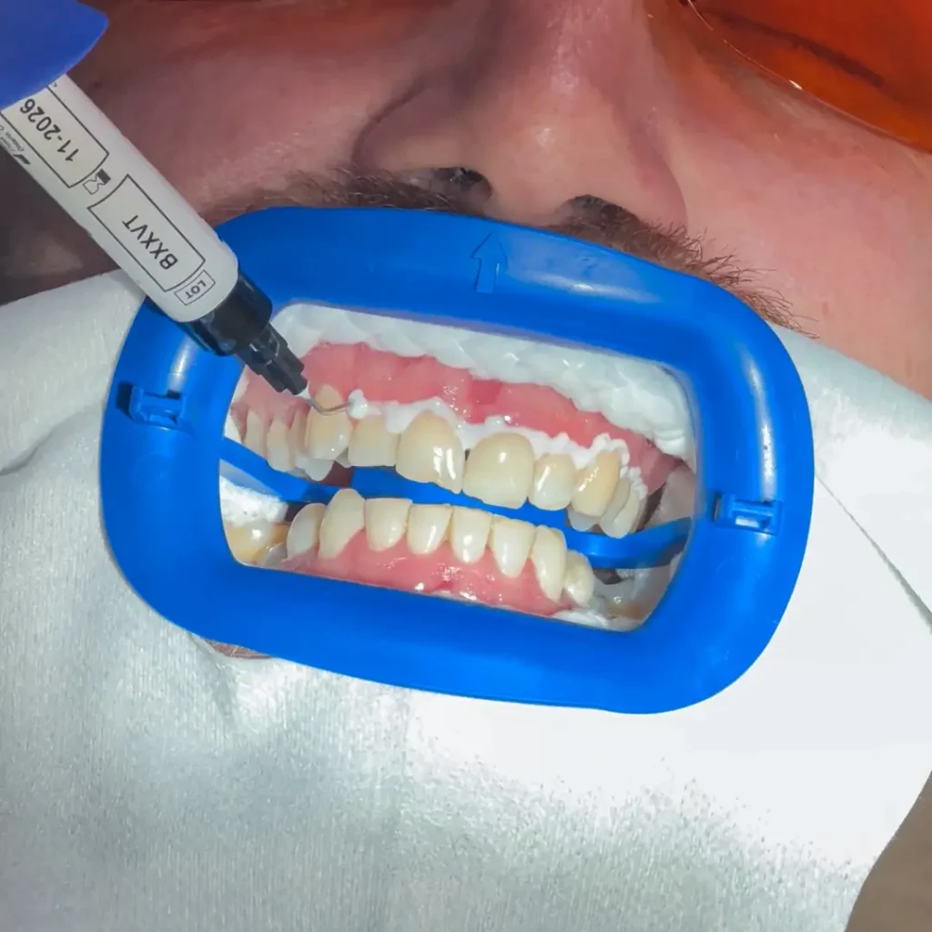 The Ultimate Guide to Teeth Whitening in Brisbane: Options, Results & What to Expect